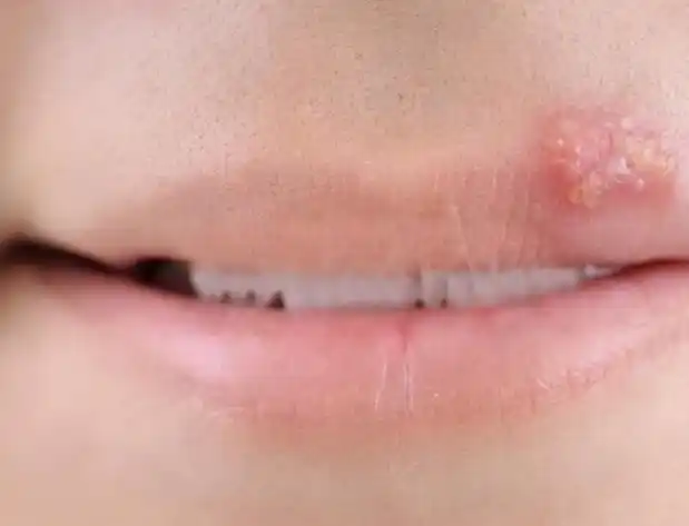 医生表示:如果嘴边长小水泡,多喝水,吃药物没有效果的话,可能是疱疹