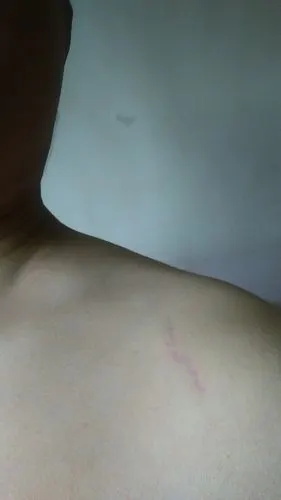 肩膀处,好像被硬东西压出来的,发现一个月了,平常有撑双杠,是不是撑