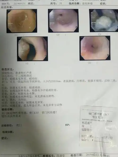 贲门肿物腹腔镜辅助近端胃切除术