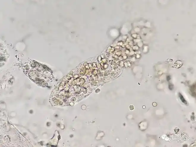 多图对比血液管型与血红蛋白管型鉴别