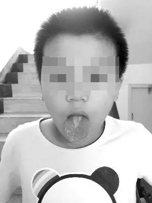 孩子漱口舌头被灼伤