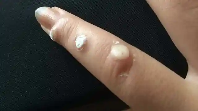 瘊子不痛不痒不舒服我来告诉你不花钱就可以让他滚蛋