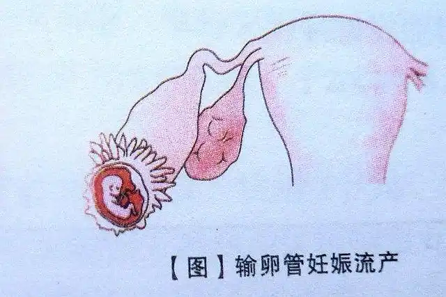 18岁女孩深夜腹痛难忍医生考虑宫外孕妈妈我女儿还是单身