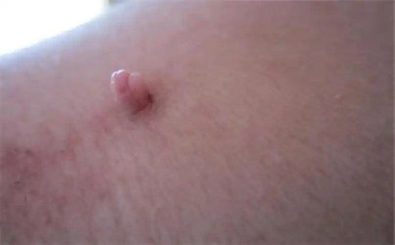 假尖锐湿疣白醋测试图片_有来医生