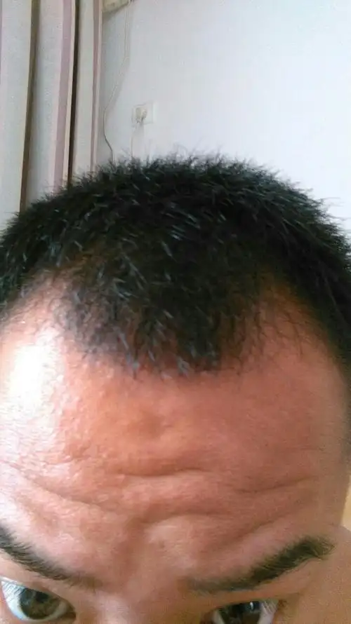 没有遗传基因,爸妈头发都挺好的.希望有过经历的朋友有啥方法可以传授