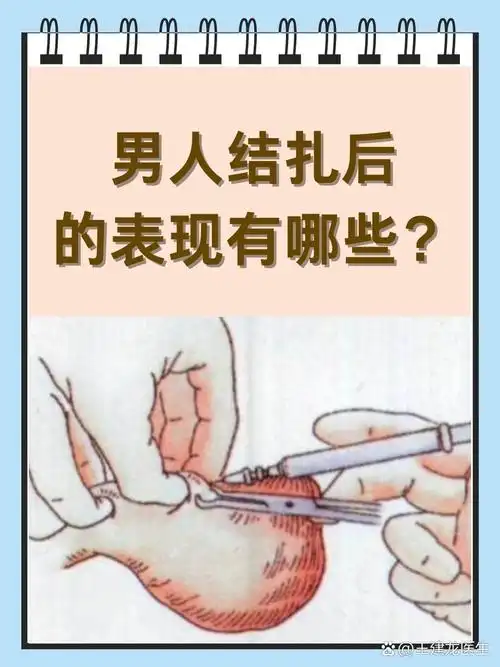 男人结扎后的表现有哪些  在生活中,当谈到避孕方式时,男人结扎成了