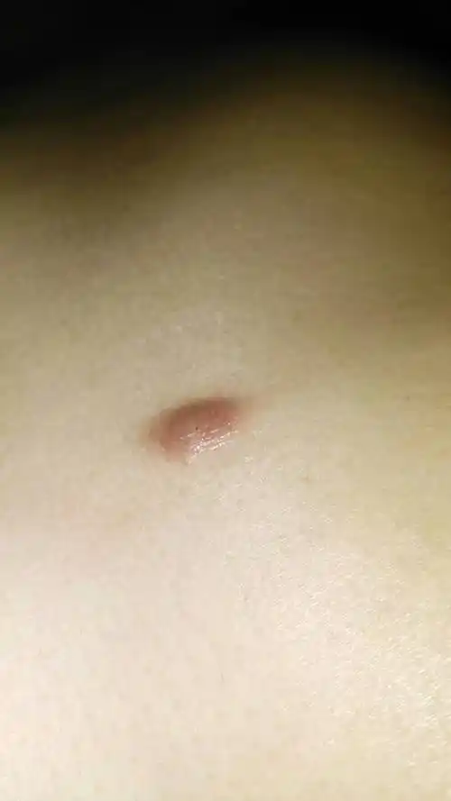 开始身上起了一个粉刺,我给挤掉了,之后就成一个硬疙瘩,都快一年了