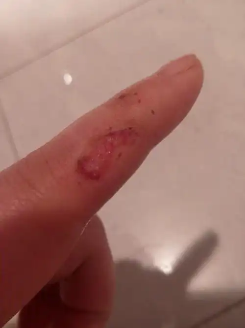 手指被刀割掉了一大块皮,每次消毒前,需要把之前涂上的云南白药用棉签