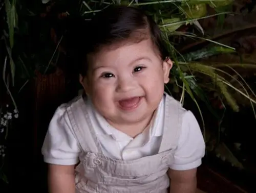 马鞍鼻图片轻度唐氏综合症的图片宝宝唐氏综合征图片首页上一页56789