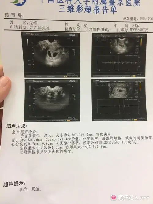 双胎,姐妹们帮忙看看男女!