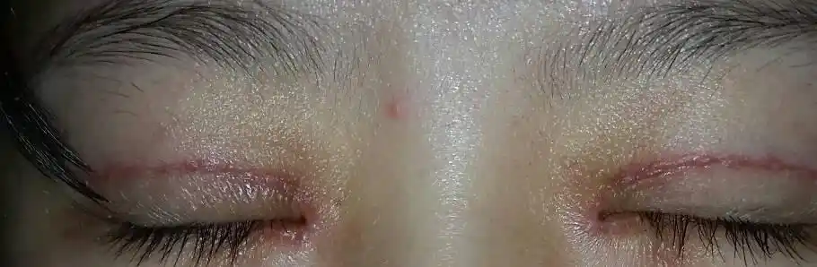 刚割完双眼皮开完眼角 疤痕增生比较严重怎么办?