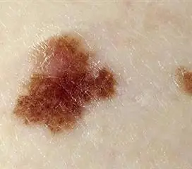 单纯性雀斑样痣