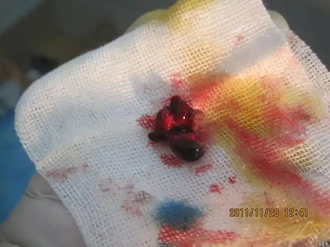 病人只要求做血栓痔术前术后图片谈论第二例