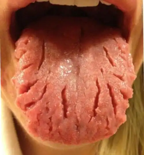 这个舌头裂开了是什么情况不知道还要输入多少字百度才可以让我问