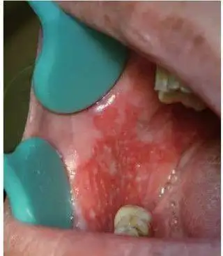 5,睾丸癌,骨癌睾丸癌和骨癌早期症状类似,都是疼痛.