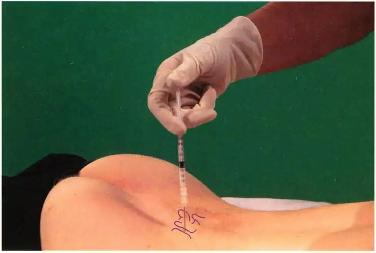 《镇痛注射技术图谱》——脊柱注射疗法:腰椎小关节注射