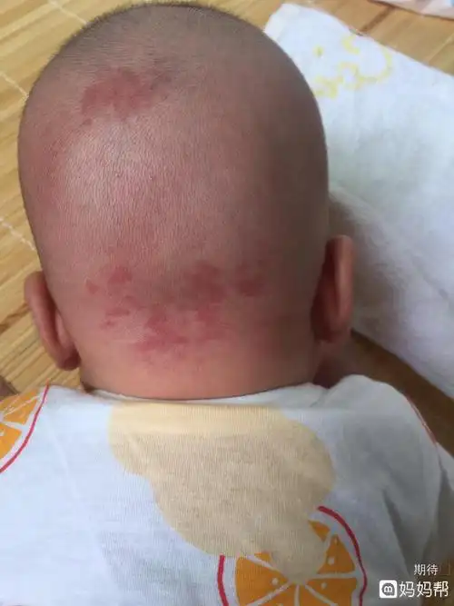 鲜嫩!新生儿荨麻疹症状"不离不弃"-第1张图片-忘川博客