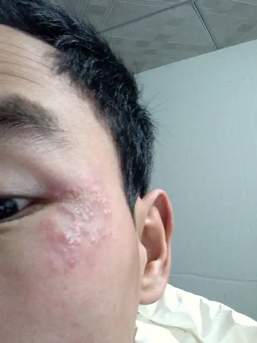 眼角起疮,求解决,会复发不