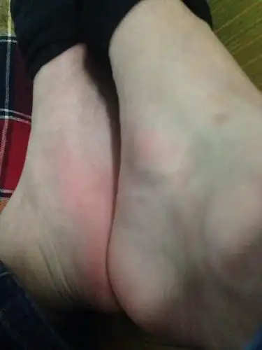 右脚脚踝内侧突出一块骨头,平时也不疼,请问有没有手术必要?