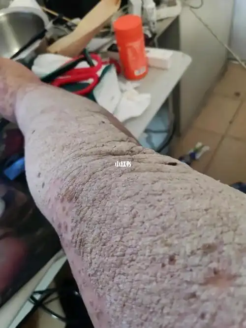 并死亡时,旧的皮肤堆积,而不是脱落,凸起的红色斑块形成了白色鳞片