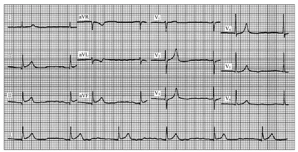 心率缓慢而规则