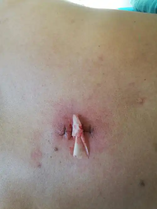 外院背部皮脂腺囊肿术后复发美容科手术治疗 - 好大夫在线