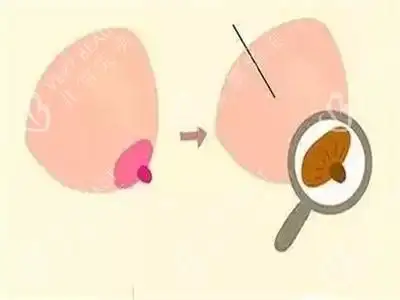 对颜色不满意可以做乳头漂红漂粉,保持少女的樱桃粉嫩.