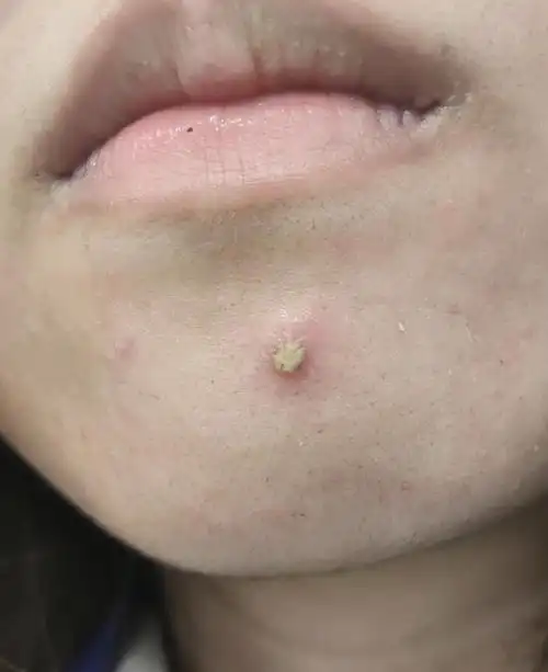 求助慎入这么巨大的痘痘要怎么快速处理啊sos