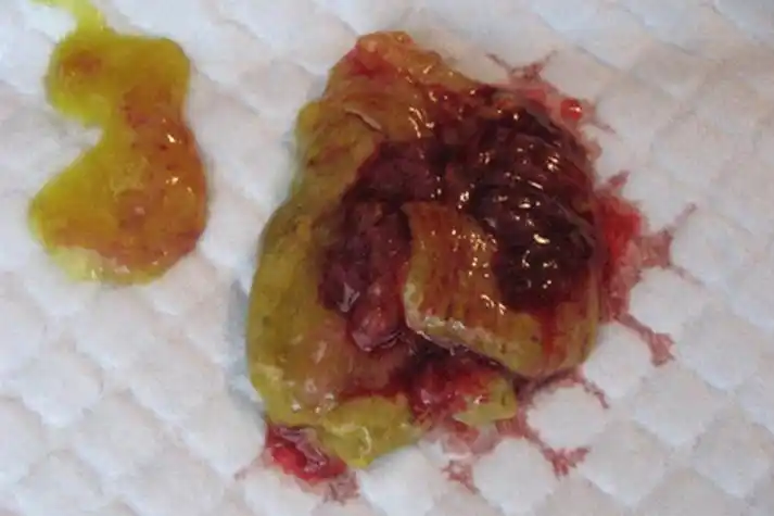 肿瘤进展可出现便秘与腹泻交替;左半结肠癌多为浸润型,表现为便血或