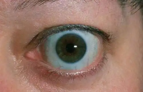 胆红素是血红蛋白的代谢产物,功能不正常时,胆红素无法正常排出,就会