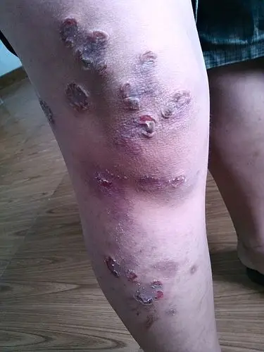 皮肤外科脓疱疮