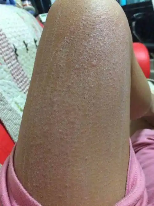 孩子有了尿布疹该如何用药更好