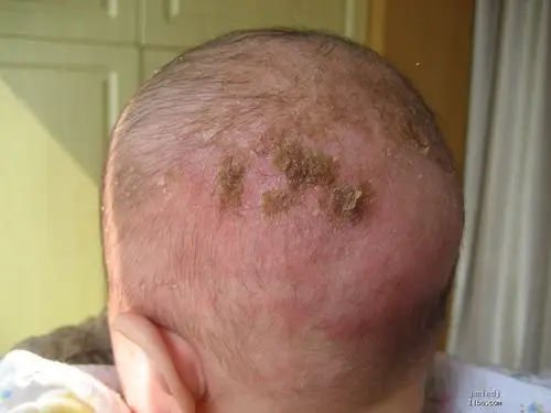 而小儿湿疹多长在脸上颈下等部位,而也有一部分宝宝头皮也会长湿疹