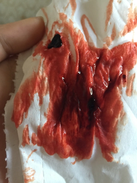 一直出血,今天突然这么多