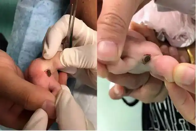 蜱虫会飞吗被这种夺命虫叮咬后如何处理