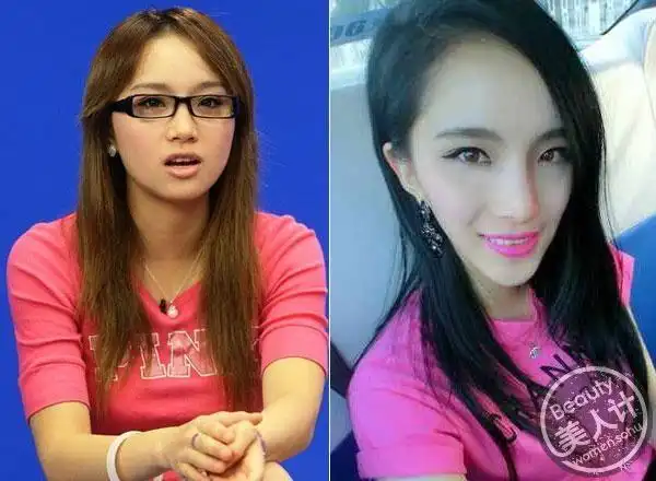 前快女整容成畸形蛇精脸 揭秘削骨血腥全程(组图)