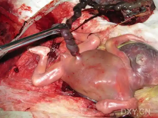 【讨论】看看这个引产的胎儿有什么异常?