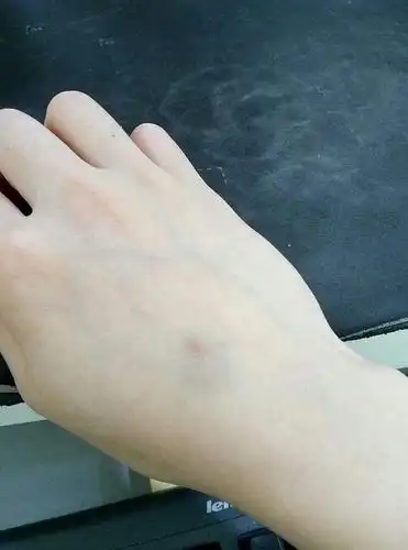 手背那里青了,不痛,也不记得有撞到哪里,然后慢.