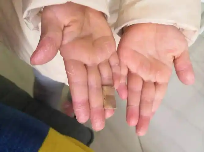 如果儿童在使用水晶泥的过程中不注意卫生,不洗手直接吃食物,硼砂可能