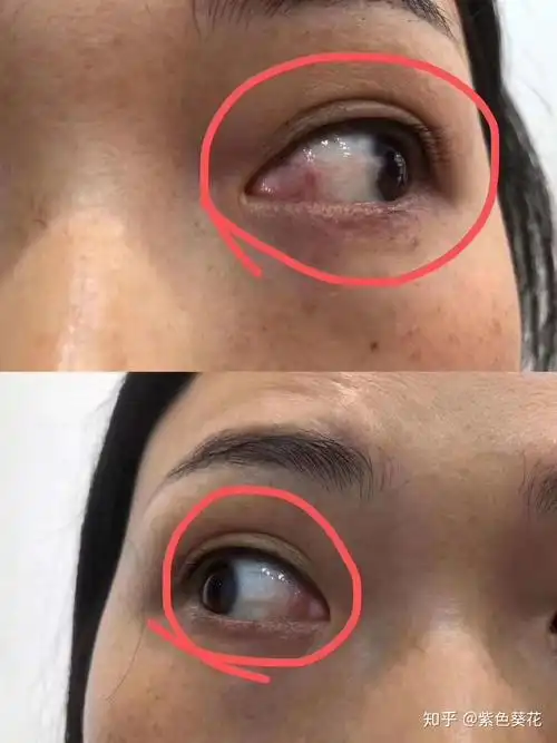 眼睛里面长息肉有什么危害? - 知乎