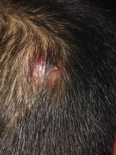 头上长了毒疮有浓了要不要挤出来 现在就是拿纸巾碰一下都见有白色的