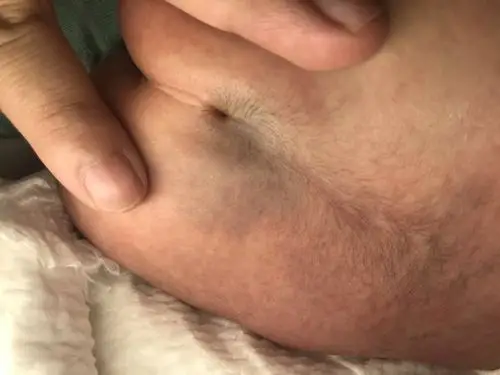 新生儿骶尾小窝与隐性脊柱裂