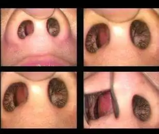 鼻中隔偏曲治疗费用