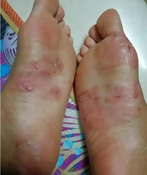 3种类型的脚气,教你对症论治