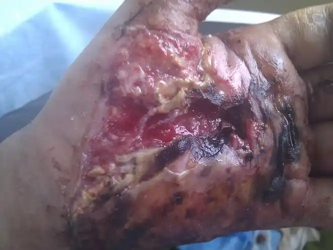 大家看看植皮成功否