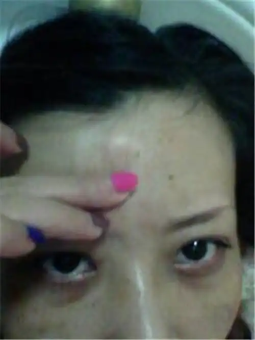 脂肪瘤图片_脂肪瘤症状表现图片大全_有来医生