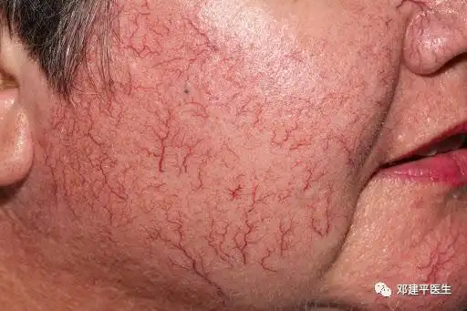 什么是毛细血管扩张(红血丝)?