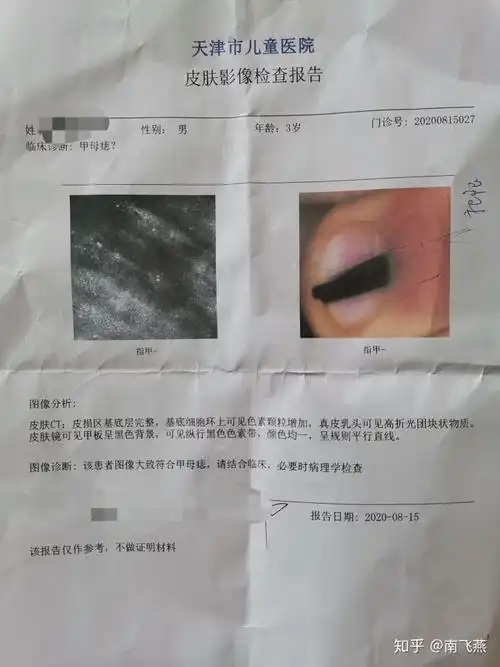 三岁甲母痣手术记录