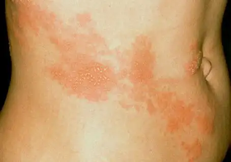 蛇缠腰症状图片