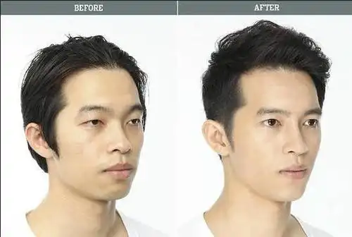 去韩国整形失败如何维权 突嘴矫正 开眼角整形前后对比照